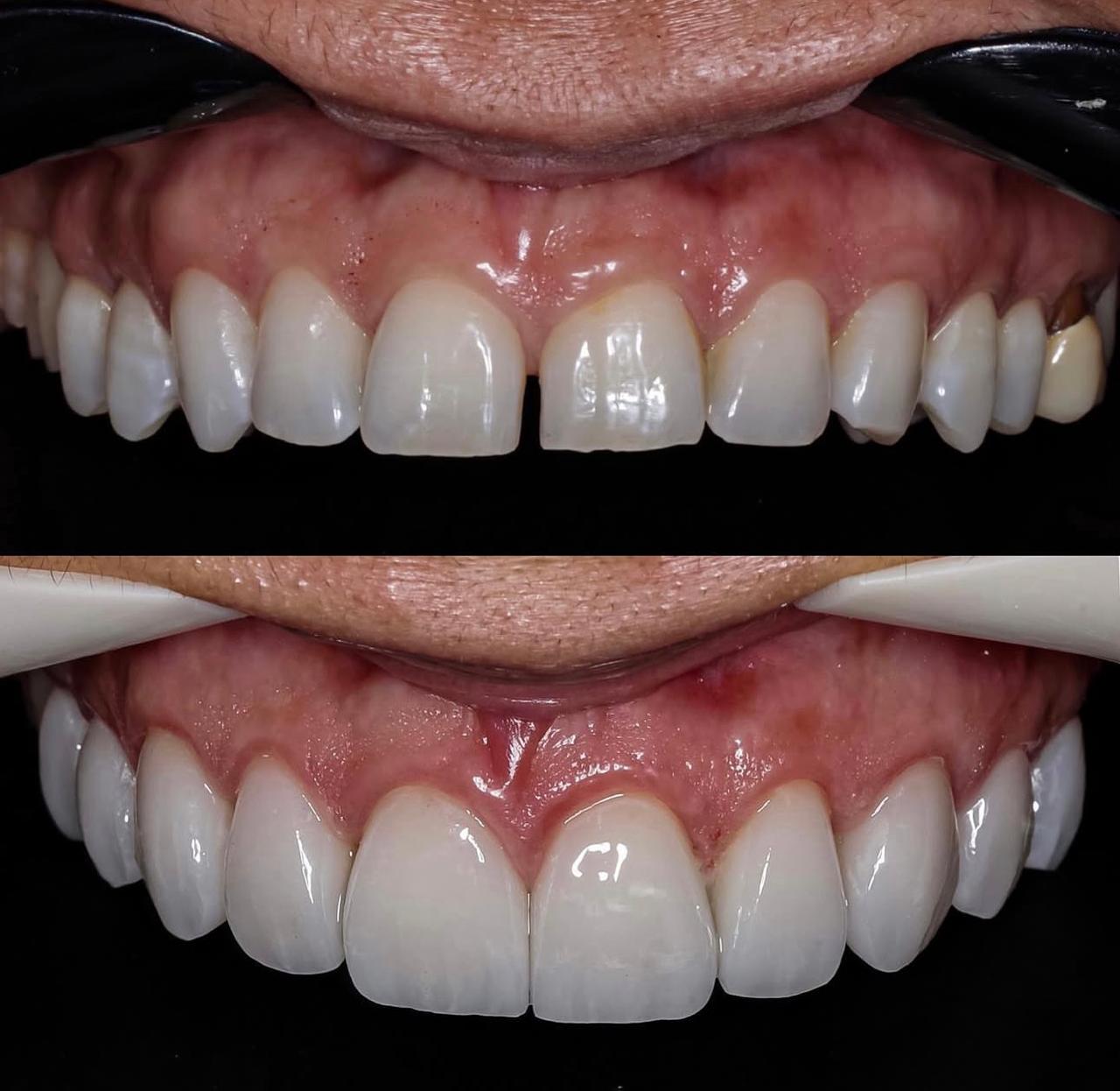 Antes e depois de sorriso 3